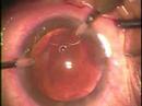 Posterior capsule laceration