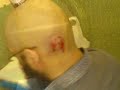 Cupping - (Arabic-Hijamah) - N.Y  Alternative Medicine Cupping
