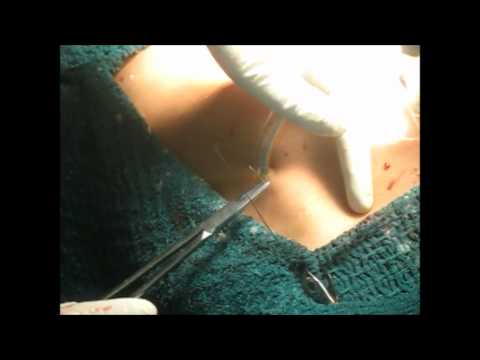 how to fasten wound healing
