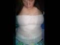 My Lapband and Tummy Tuck Before and After Pics