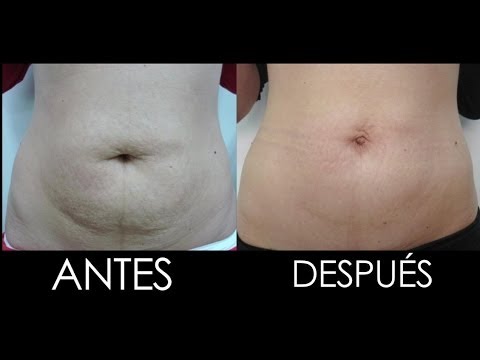 Eliminar flacidez abdomen despues embarazo Eliminar flacidez abdomen despues embarazo