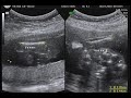 PEDRINHO ULTRASOM 09/01/08 18 SEMANAS