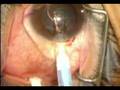 videos de ICL Surgery (Alaas)