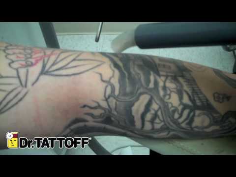 Tattoo removal before and after - half sleeve