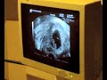 2nd twins Ultrasound 2nd twins Ultrasound