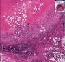 Histopathology Lymph node--Brucellosis