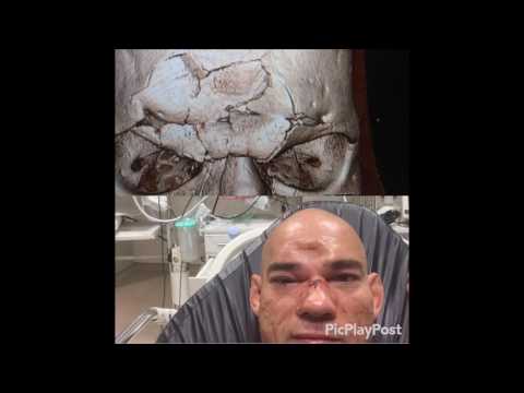 Cyborg Santos Post-Surgery Skull Pictures Are Insane