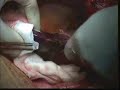 Click here to watch this video Habib 4X in liver resection in a patient with situs inversus