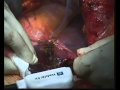 Habib 4X in liver resection in a patient with situs inversus