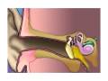 Malpractice Medical Myringotomy Insertion of Tube