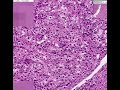 Histopathology Kidney--Renal cell carcinoma Renal Cell Cancer