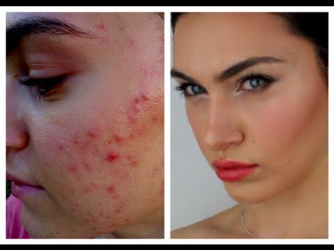 how to cover up acne with makeup