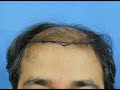 Alpha (4100 FUHT grafts) 1 year result