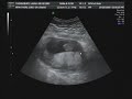Ultrasound 20 weeks 3 days