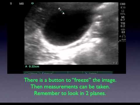 how to perform aortic ultrasound