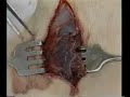 Debridement - 3 Debridement - 3