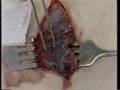 Debridement - 3