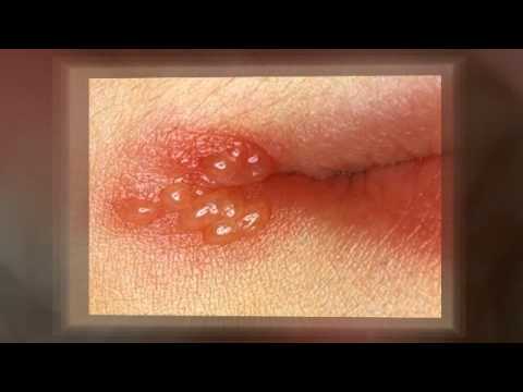 how to control oral herpes