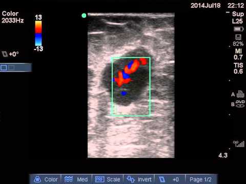 how to drain occipital lymph nodes