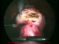 pembedahan laparocopy hysterectomy