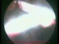pembedahan laparocopy hysterectomy