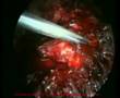 pembedahan laparocopy hysterectomy