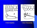 Large Chin Augmentation with Dr. Barry Eppley Large Chin Augmentation with Dr. Barry Eppley