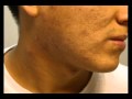 The Acne Practice  (relentless moderate case)