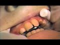 placing an rpe part 1