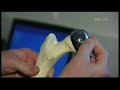 ASR Hip Resurfacing