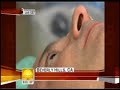 Live Visian ICL on NBC Today Show Live Visian ICL on NBC Today Show