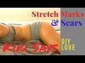 How to Reduce Stretch Marks and Scars - Natural