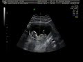 Baby 1 Ultrasound, 12 Weeks