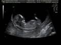 Baby 1 Ultrasound, 12 Weeks