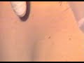 Intercostal Nerve Block