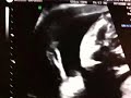 Baby Gray 20 Week