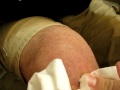 spider bite - draining pus