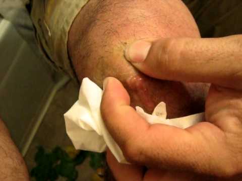 how to treat spider bites nz
