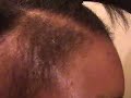 Hairline growth (update)