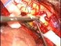 Spinal Hemangioblastoma