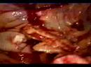 thoracic hydatidosis thoracic hydatidosis
