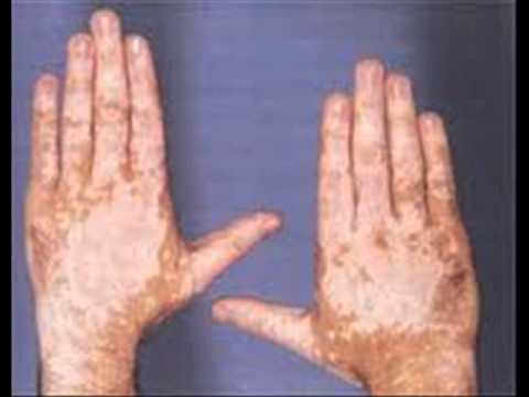 how to cure idiopathic guttate hypomelanosis