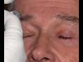 Mesotherapie - Sch�nheit