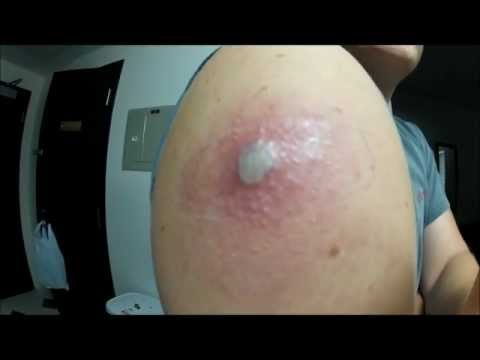 how to administer smallpox vaccine