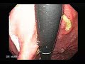 Endoscope Endoscopy Colonoscopy Gastroscope