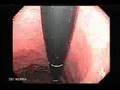 Endoscope Endoscopy Colonoscopy Gastroscope