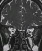 Spontaneous CSF leak - CISS MRI images