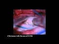Meningeoma C2-C3