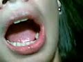 3rd molar extraction 3rd molar extraction