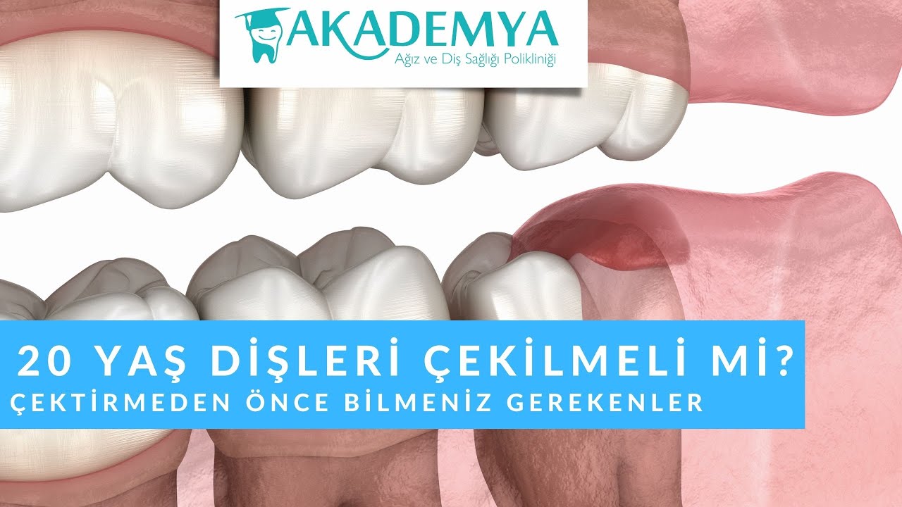 20 Yaş Dişleri Hakkında